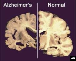 Não của người mắc chứng Alzheimer (trái) so với não của người bình thường