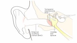 Điếc sau khi chấn thương đầu